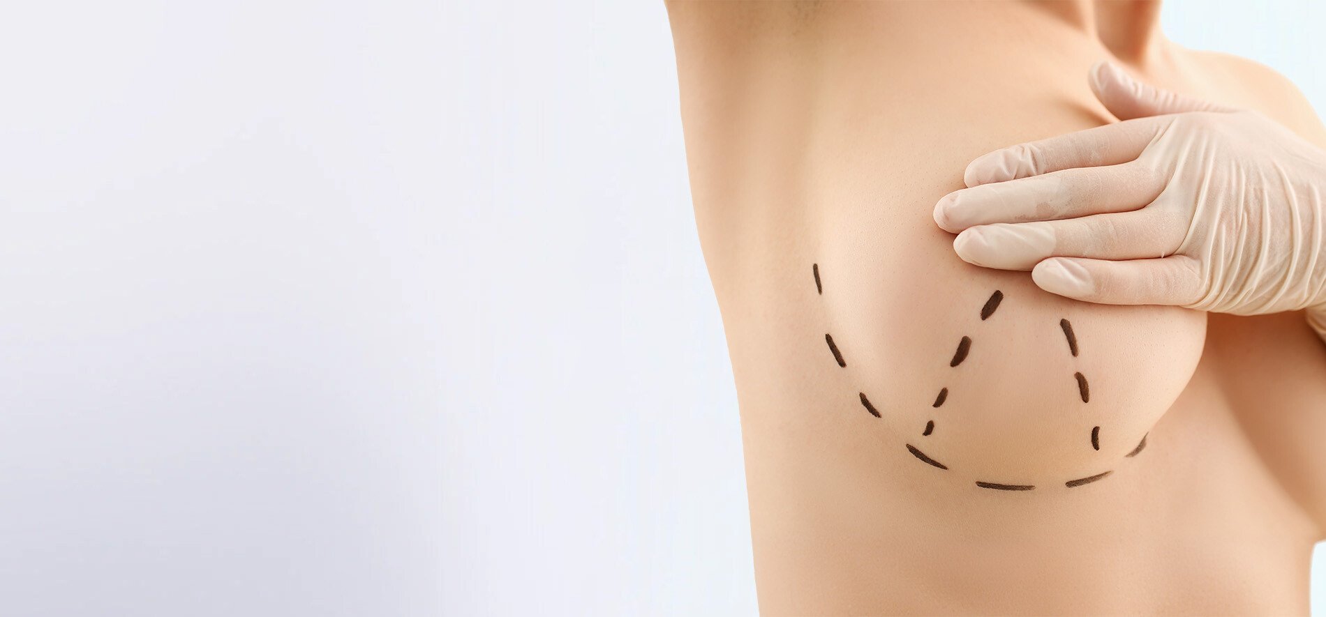 Breast Implant Revision Surgery banner