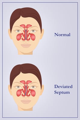 PSC - Infographic - Functional Rhinoplasty (1)