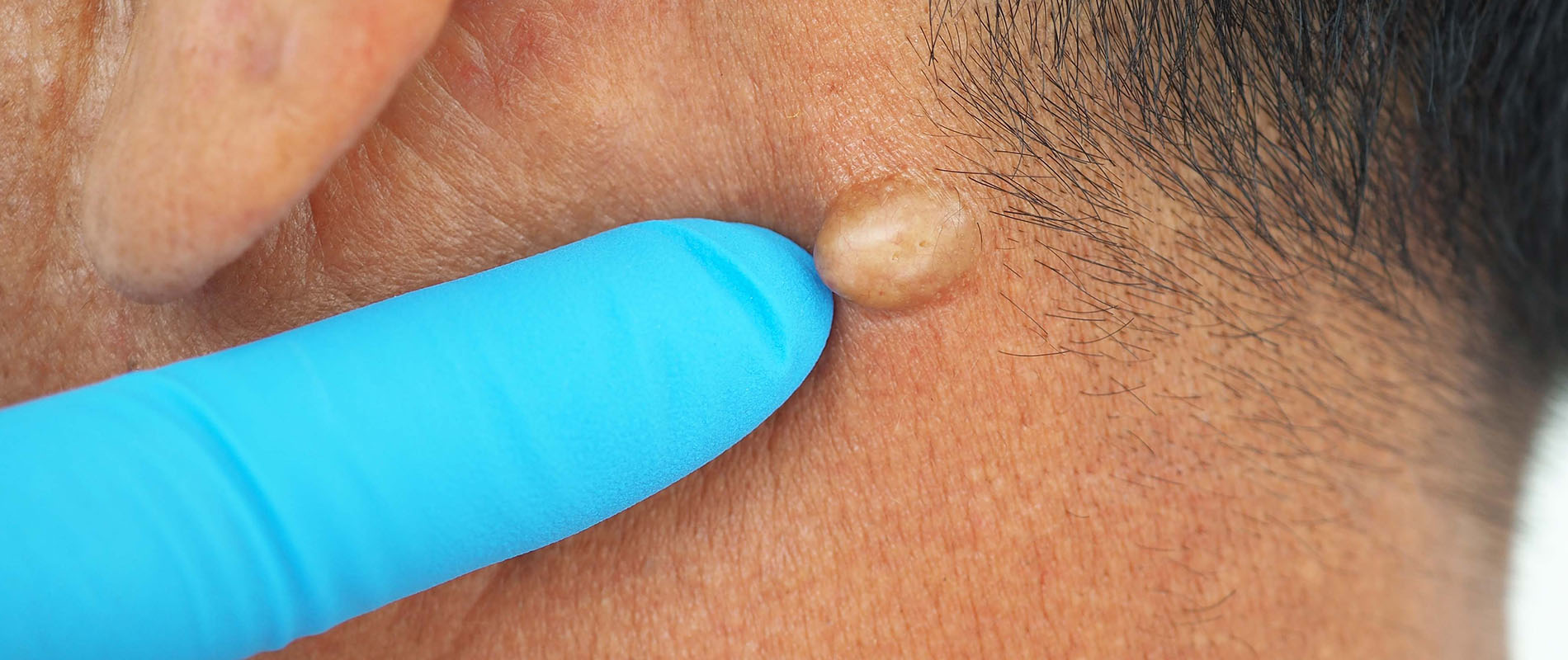 Man pointed to sebaceous cysts on his neck, formed by sebaceous glands