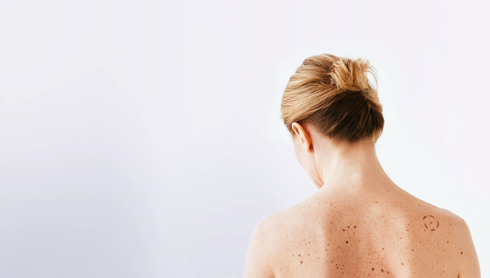 back view of woman with marks on skin top banner