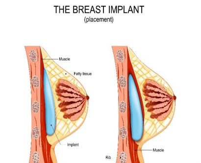 How Will Breast Implants Affect Exercise? - Watterson Plastic Surgery
