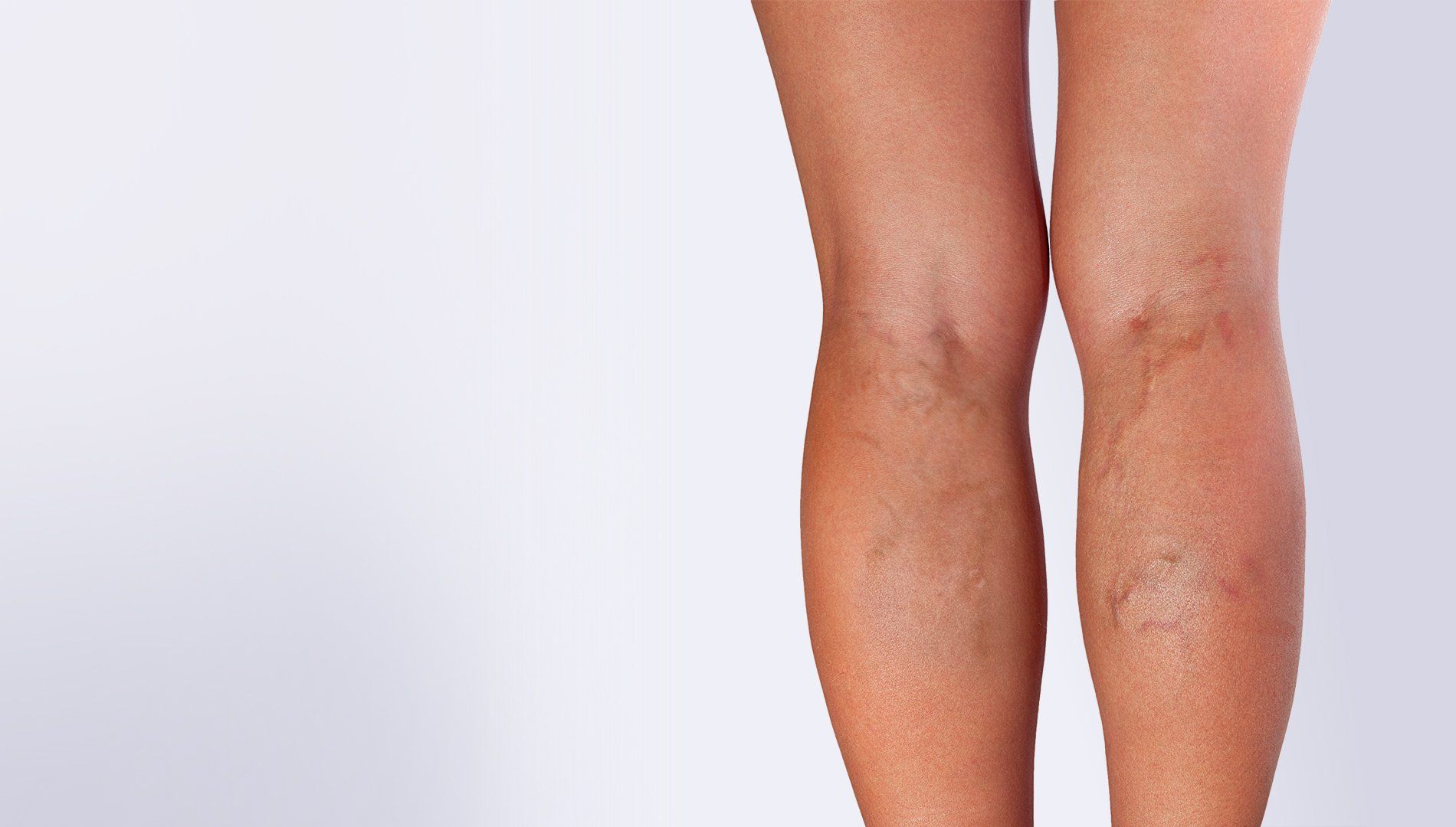 What to Expect from Your First Laser Vein Treatment Session